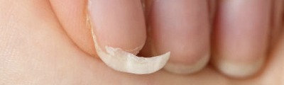 A broken nail needing a fix